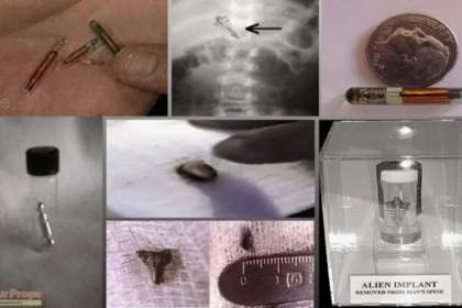 Remoções e análises de implantes alienígenas por parte do Dr. Roger Leir.