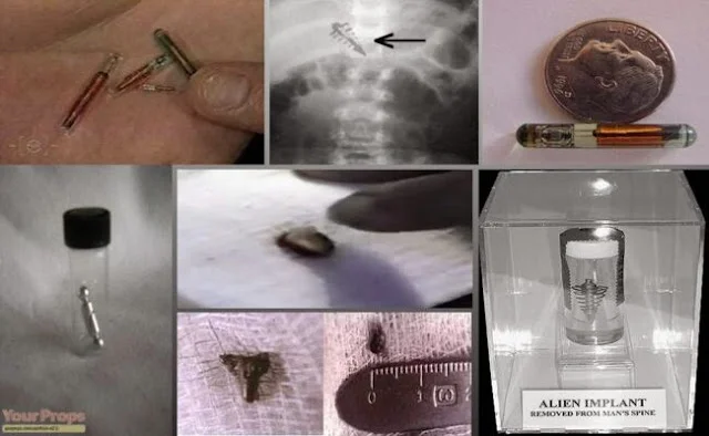 Remoções e análises de implantes alienígenas por parte do Dr. Roger Leir.